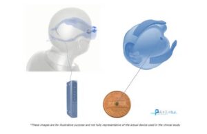 Прорыв в области интерфейсов мозг-компьютер: предварительные результаты клинических испытаний имплантата Prima Retina